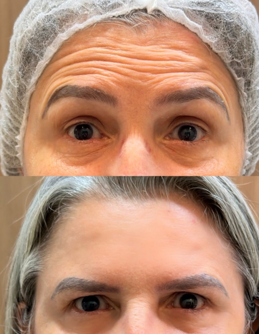 Toxina Botulínica (Botox)