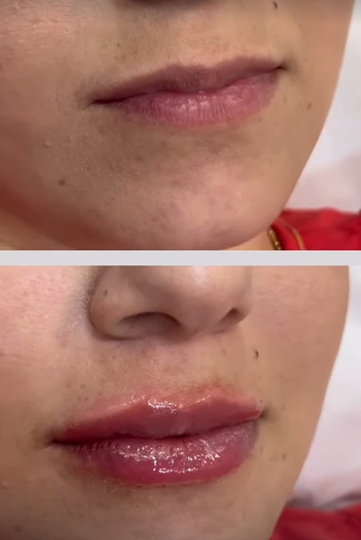Preenchimento Labial